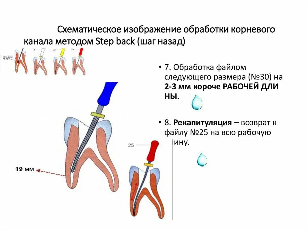 1 корневой канал. Апикально корональные методы обработки корневых. Степ бэк обработка корневых каналов. Стандартный метод обработки корневых каналов. Расширения корневого канала “Step back”. Инструменты..