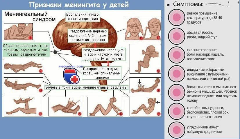 Светобоязнь и головная боль. Менингеальные симптомы у детей до 1 года. Первые симптомы менингита у детей. Менингеальные симптомы у детей 8 лет. Инфекционный менингит симптомы.