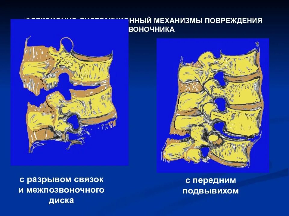 Повреждения позвоночника переломы. Флексионно ротационный перелом позвоночника. Сгибательный механизм травмы позвоночника. Перелом позвоночника механизм повреждения. Флексионный перелом позвонка.