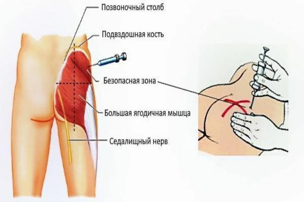 Простакор как колоть. Простакор внутримышечно. Простакор уколы. Инъекция в ягодицу. Укол внутримышечно.