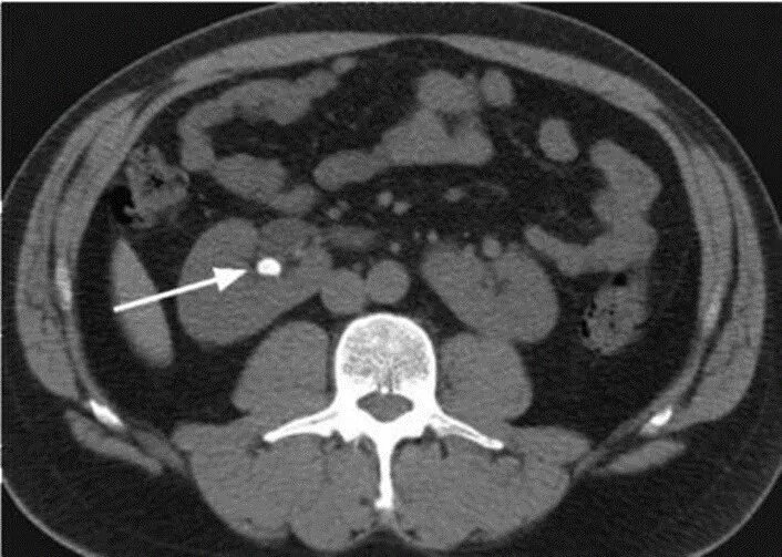 Камни на кт видны. Кт почек мочекаменная болезнь. Мочекаменная болезнь кт. Компьютерная томография мочекаменной болезни.