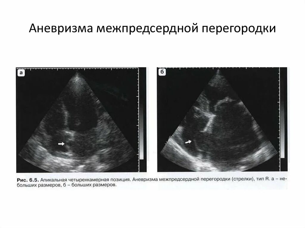 Эхокардиография аневризма МПП. Аневризма МПП на ЭХОКГ. Аневризматическое расширение межпредсердной перегородки. УЗИ сердца, аневризма межпредсердной перегородки