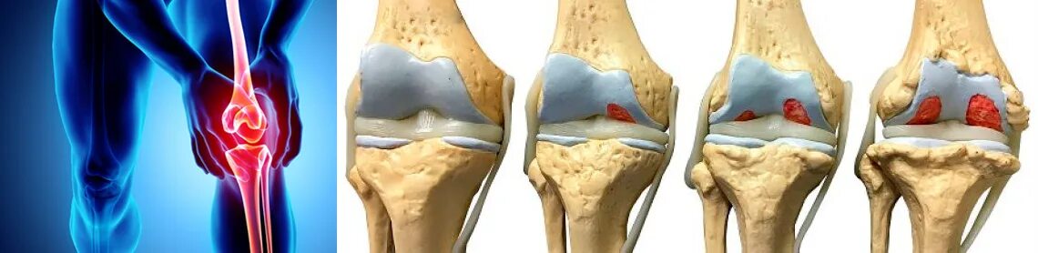 Артроз коленного сустава мениск. Гонартроз менисцит коленного сустава. Артрозо-артрит коленного. Артроз коленных суставов (гонартроз).