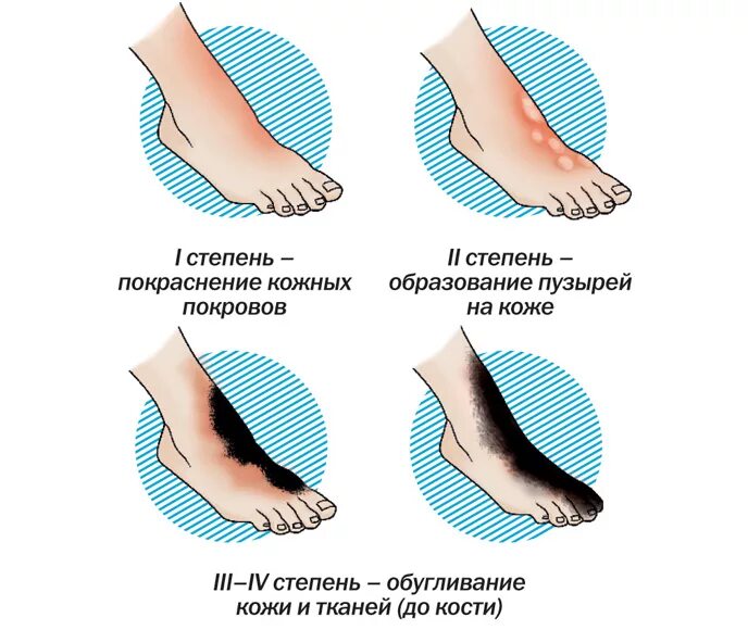 Первая стадия. Степени ожогов 4 стадии.