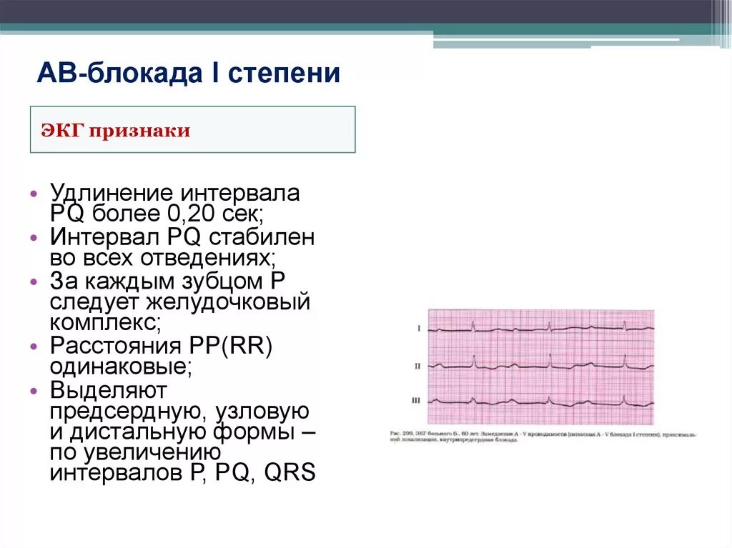 Номер блокады. Неполная АВ блокада 1 степени на ЭКГ. Ab блокада 1 степени ЭКГ. ЭКГ при АВ блокаде 1 степени. Кардиограмма АВ блокада 1 степени.