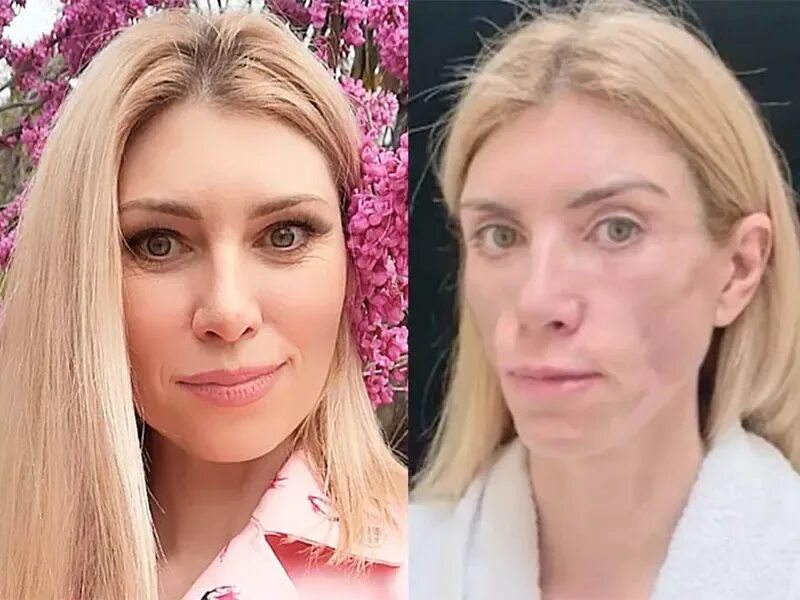 Юля после пластики