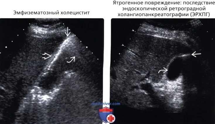 Гиперэхогенные включения в желчном пузыре