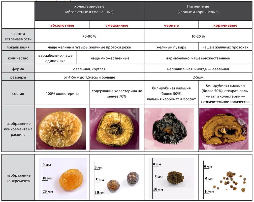 Камень холестерина. Классификация камней желчного пузыря. Виды камней желчекаменной болезни. Желчнокаменная болезнь типы камней. Классификация камней при желчекаменной болезни.
