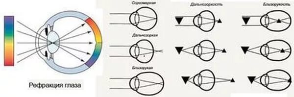Фокусировка лучей света на внутренней поверхности. Варианты нарушения рефракции глаза. Аномалии рефракции глаза близорукость дальнозоркость астигматизм. Миопия схема преломления лучей. Схемы рефракции при нормальном зрении.