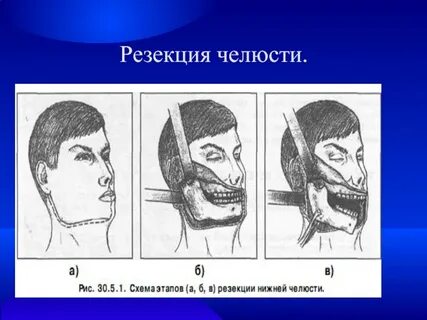 Удаленная нижняя челюсть