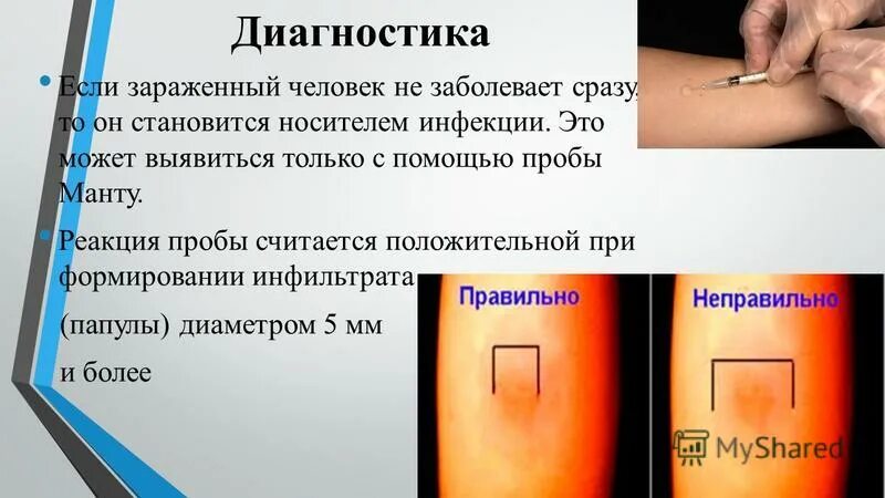 Реакция манту проводят начиная с возраста. Реакция манту в 1 год норма. Нормальный размер манту.