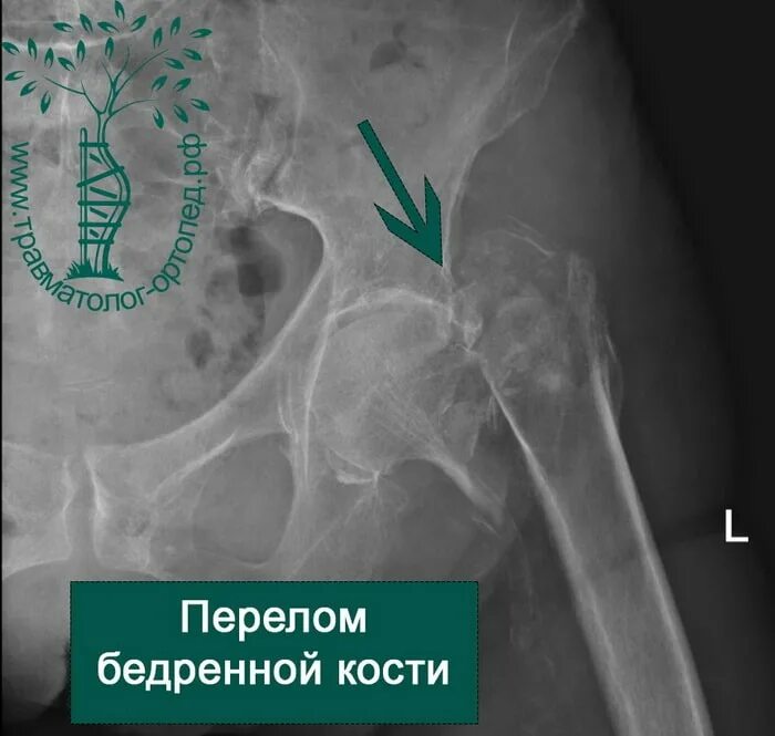 Подвертельный перелом бедра. Чрезвертельный перелом операция. Чрезвертельный перелом бедренной. Закрытый чрезвертельный перелом. Перелом бедра лечение без операции