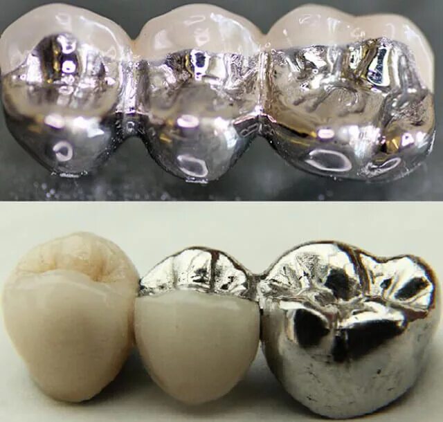 Сколько стоит металлические зубы. Коронка цельнолитая (никель хром). • Цельнолитые коронки и мостовидные протезы. Мостовидный протез металл керамика. Металлокерамическая коронка а1 120.