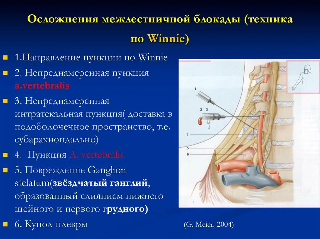 Блокада сплетения. Регионарная анестезия межлестничная. Блокада плечевого сплетения межлестничным. Проводниковая межлестничная анестезия. Регионарная анестезия плечевого сплетения.