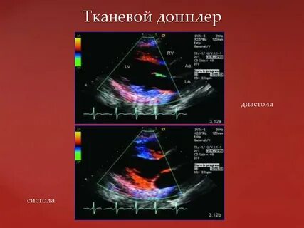 Спектральная допплерография