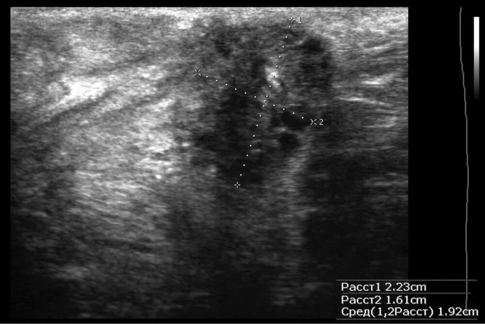 Гранулема послеоперационного рубца на УЗИ. Серома на УЗИ что это послеоперационного рубца. Эндометриоз послеоперационного рубца на УЗИ.