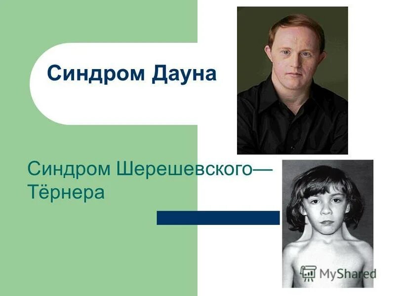 синдром шерешевского тернера геномная мутация