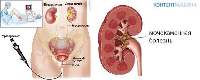 Почечнокаменная болезнь камни. Камень в мочеточнике у мужчин схема. Мочекаменная болезнь урология камни мочеточника. Мочекаменная болезнь операция.