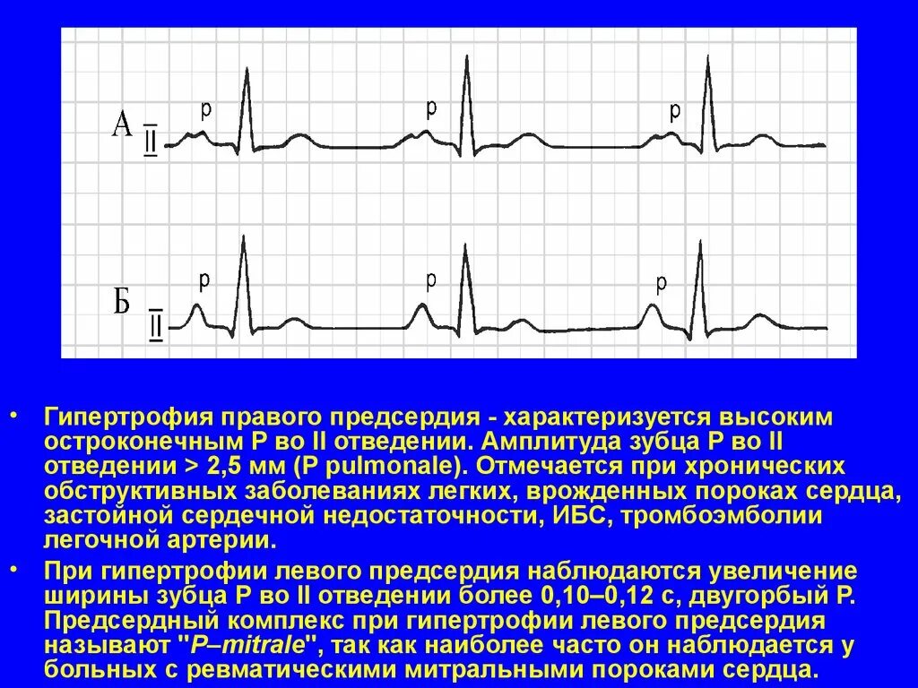 Признаки увеличения предсердий