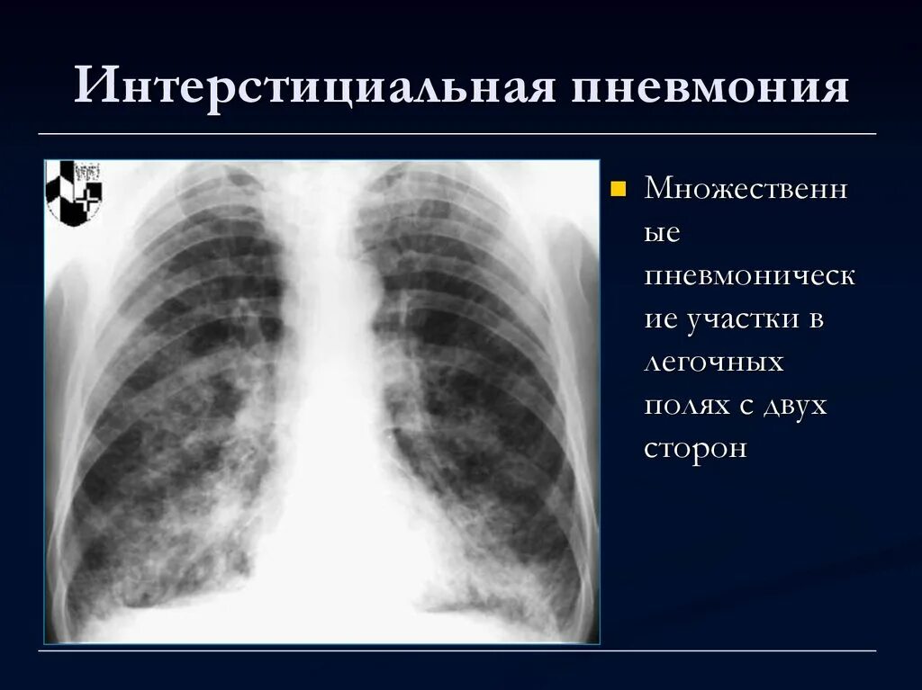 Интерстициальная пневмония рентген. Идиопатическая интерстициальная пневмония рентген. Неспецифическая интерстициальная пневмония рентген. Острое поражение легких