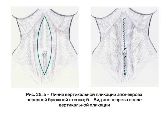 Апоневрозы мышц передней брюшной стенки. Дефект апоневроза передней брюшной. Диастаз брюшной стенки. Пластика дефекта передней брюшной стенки.