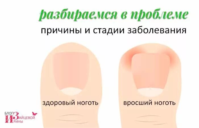 Схема врастания ногтя на ноге. Как подстригать ногти на большом пальце