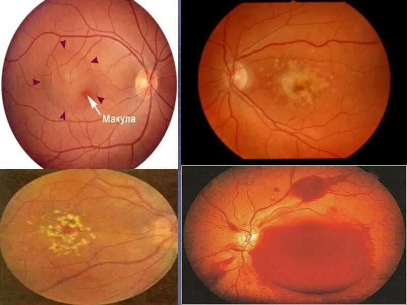 Прима макула. Макулодистрофия друзы. Экссудативная макулопатия. Макулодистрофия, макулярная дегенерация. Центральная хориоретинальная дегенерация сетчатки глаза.