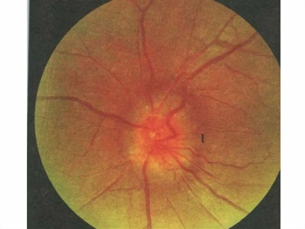 Ретробульбарный неврит. Вал вдавления в офтальмологии на сетчатке.