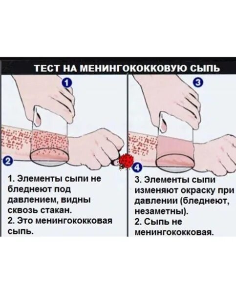 Локализация сыпи при краснухе и кори - фото презентация