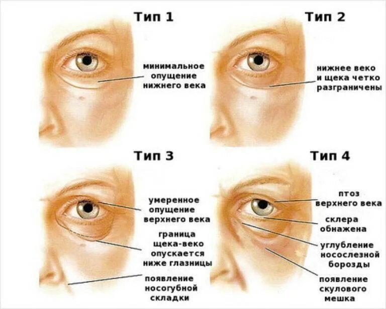Веко верхнее птоз 1 степени. Птоз ( опущение верхнего века. Степени птоза Нижнего века. Птоз глаз Нижнего века.