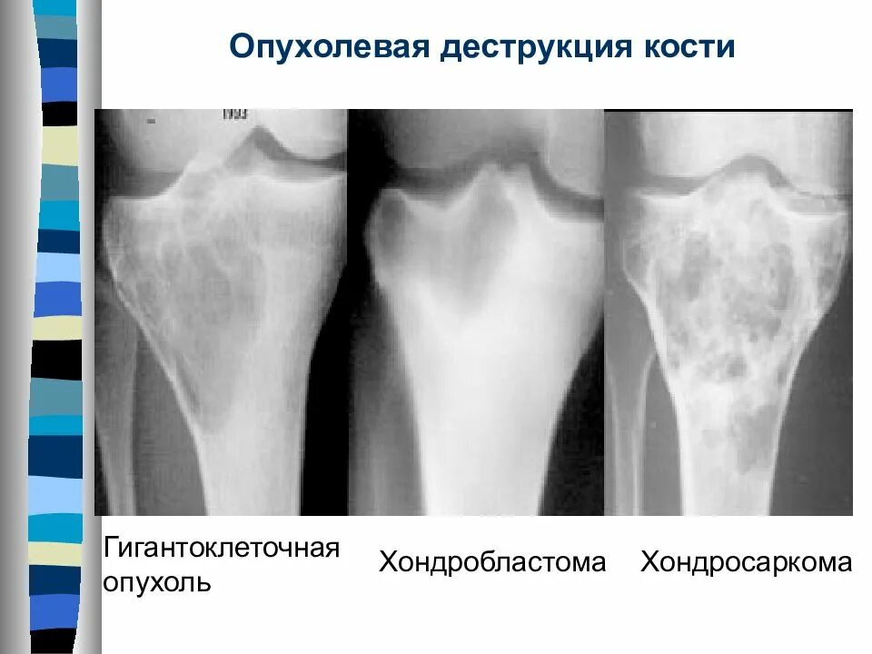 Очаговые изменения костей. Гигантоклеточная опухоль большеберцовой кости. Очаг деструкции большеберцовой кости. Очаг деструкции костной ткани рентген. Хондросаркома тазобедренного сустава.