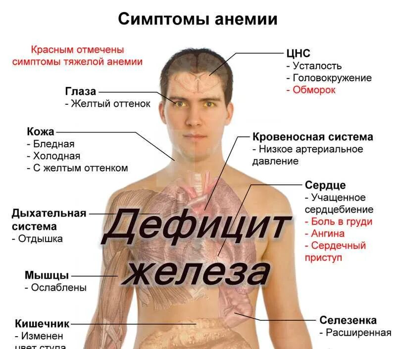 Сердечная анемия. Люди с низким гемоглобином. Низкий гемоглобин симптомы. Признаки низкого гемоглобина.