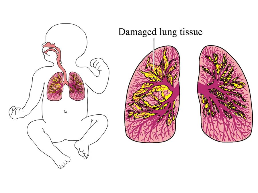 Поражение тканей легких. Острые пневмонии у детей раннего возраста. Пневмония новорожденных легкие. Пневмония у детей симптомы легкие. Поражения на легких у детей.