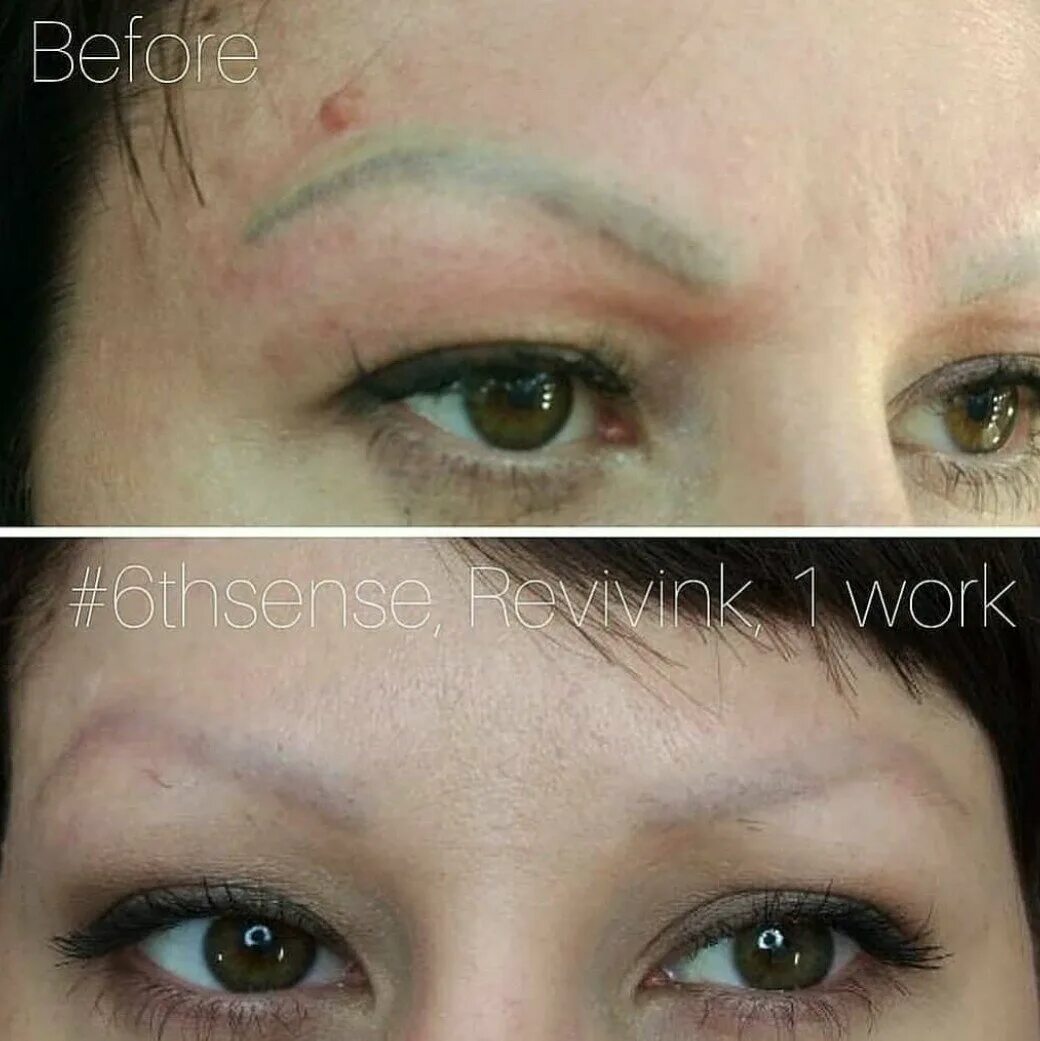 удалить татуаж бровей ревайвинком. удаление татуажа ревайвинк. удаление зеленых бровей ревайвинком. ревайвинг для удаления татуажа. ревайвинк revivink 6th sense фот.