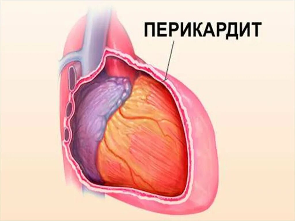 Перикард у детей. Хронический туберкулезный перикардит. Инфекционный перикардит. Хронический слипчивый перикардит. Перикардит с тампонадой сердца.