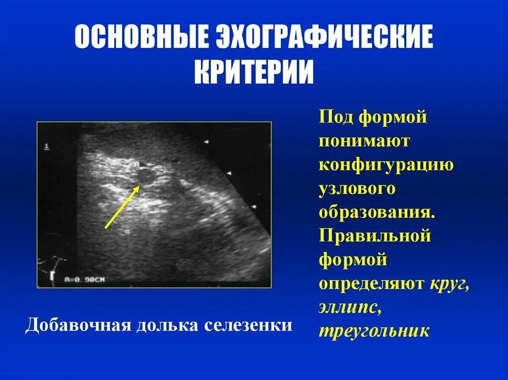 Дополнительная долька селезенки на УЗИ. Эктопированная долька селезенки. Удвоение селезенки на УЗИ.