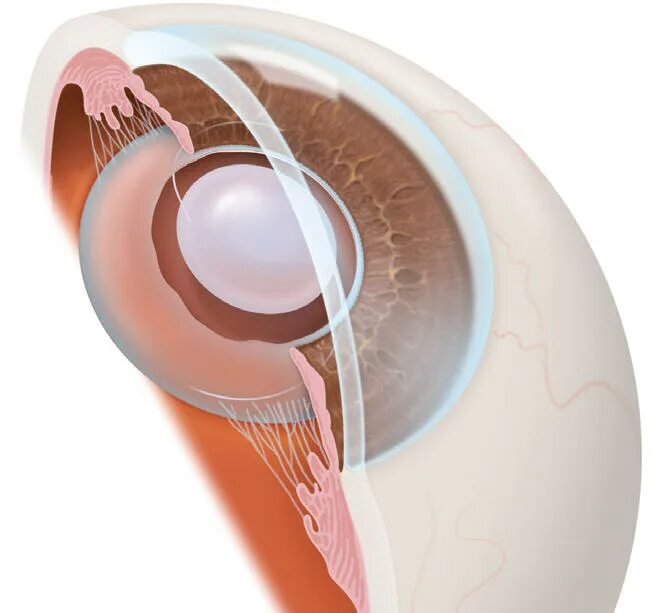 Искусственный хрусталик. Прозрачный хрусталик. Факоэмульсификация катаракты.