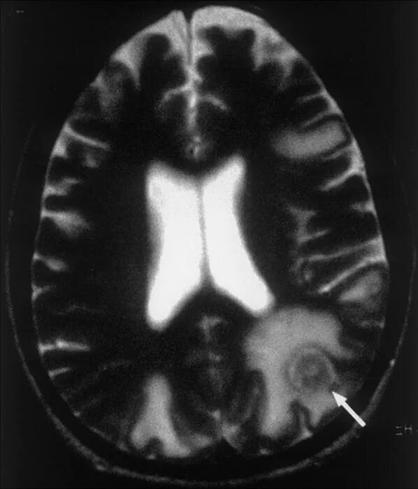 Множественные метастазы в головной мозг. Метастазы в головном мозге симптомы и признаки. Метастазы головного мозга при ВИЧ.