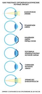 Ночные линзы при миопии