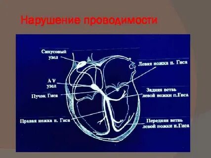 Нарушение проводящей системы