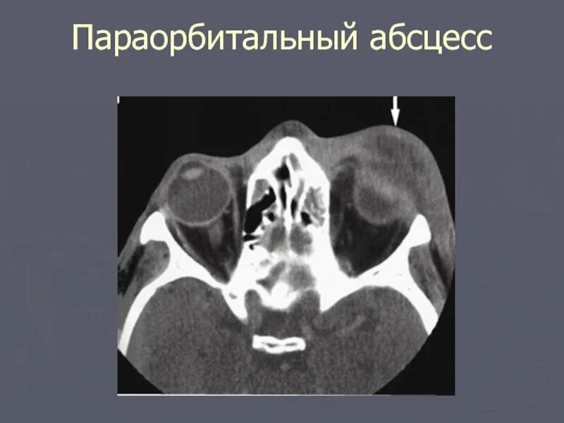 Параорбитальная. Параорбитальный абсцесс. Параорбитальная флегмона. Абсцесс параорбитальной области.