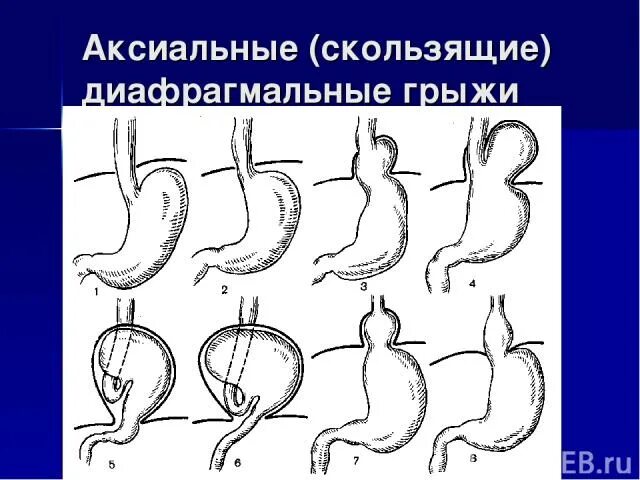 Скользящая грыжа под. Аксиально-хиатальная грыжа. Скользящая аксиальная хиатальная грыжа. Аксиальная диафрагмальная грыжа.