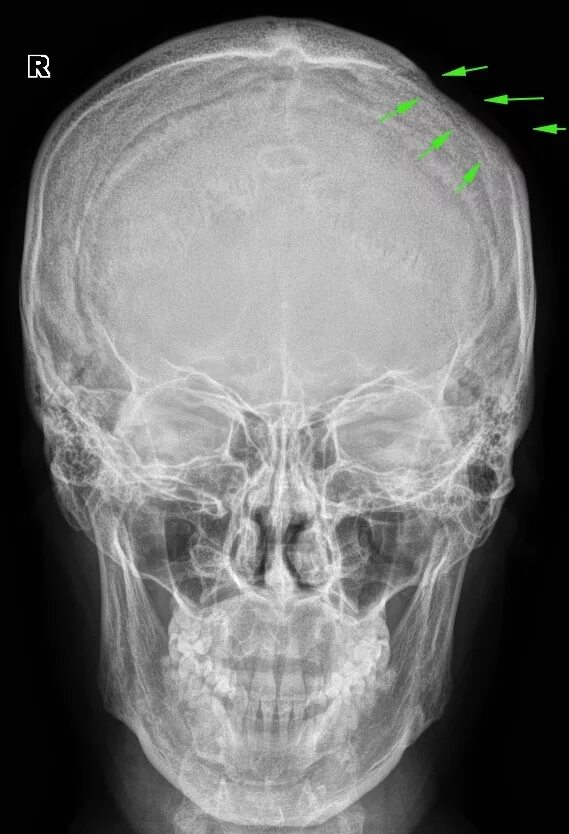 Сотрясение черепа. Перелом лобной кости рентген. Перелом костей черепа рентген. Перелом затылочной кости рентген. Перелом черепа на рентгене лобной кости.