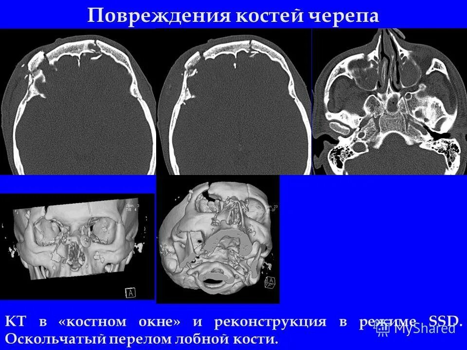 Оскольчатый перелом костей черепа. Вдавленный перелом костей свода черепа. Оскольчатый перелом костей черепа. Перелом костей черепа кт. Паутинообразный перелом костей свода черепа.