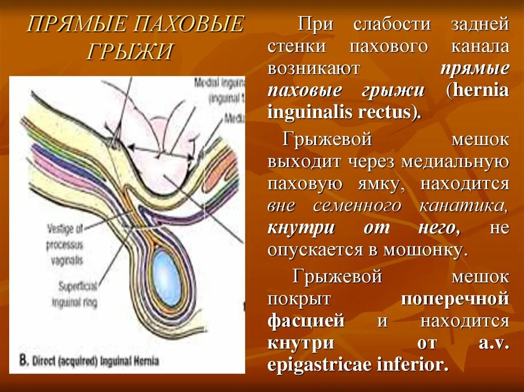 Прямая и косая паховые грыжи