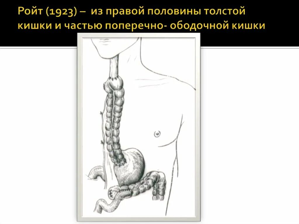 Эзофагопластика пищевода схема операции. Пластика пищевода кишечником. Операции при рубцовых сужениях пищевода. Пластика пищевода по ру-Герцену.