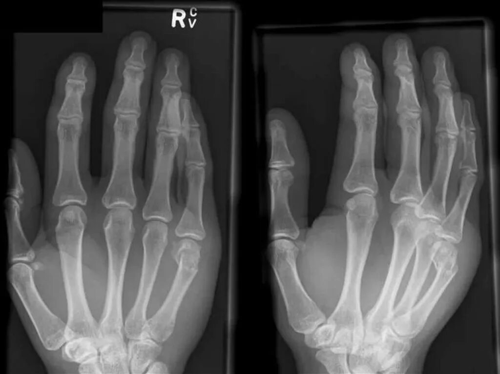 оскольчатый перелом пальца рентген. операция на пястной кости. оскольчатый перелом фаланги пальца. перелом мизинца на руке со смещением. перелом 5 пястной кисти рентген.