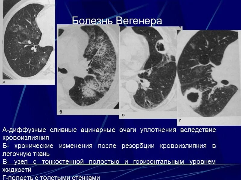 Гранулематоз Вегенера легкие кт. Интерстициальные болезни легких кт. Гранулематоз Вегенера гломерулонефрит. Синдром Вегенера поражение легких. Диффузные изменения в легких