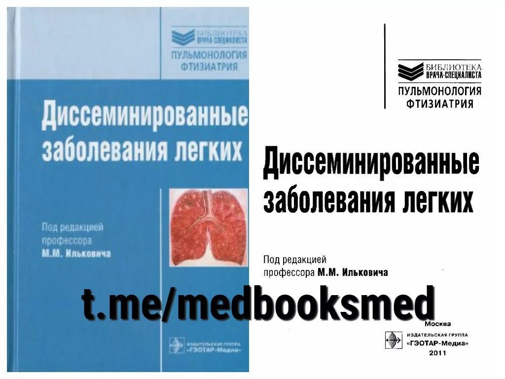 Федеральная пульмонология. Диссеминированные заболевания легких Илькович. Илькович интерстициальные заболевания легких. Пульмонология книги. Пульмонология книги интересные.