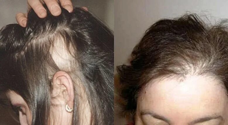 Сильно выпадают волосы на голове витамины. Экозависимая алопеция. Послеродовая телогеновая алопеция.